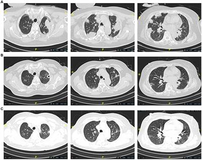 Drug-induced hypersensitivity syndrome related to piperacillin-tazobactam: a case report and review of the literature
